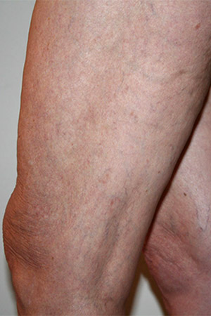 before and after varicose vein