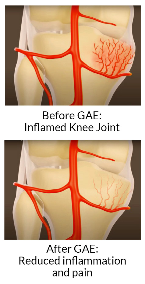 An example of before and after Genicular Artery Embolization knee pain treatment