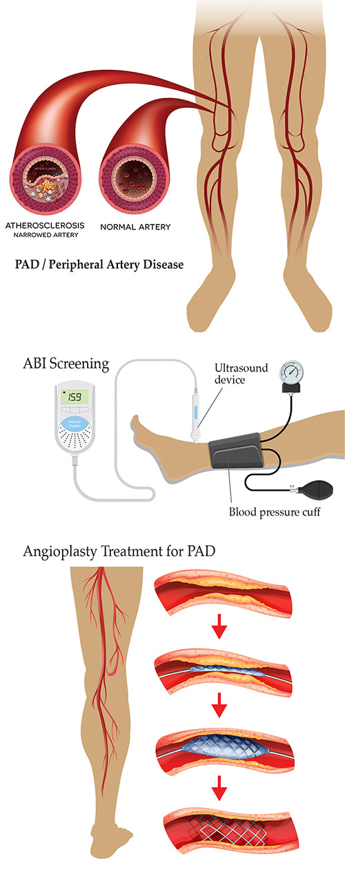 An example of peripheral arterial disease