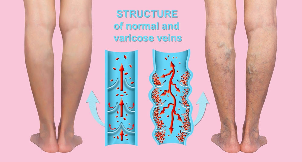 Best vein doctor near me