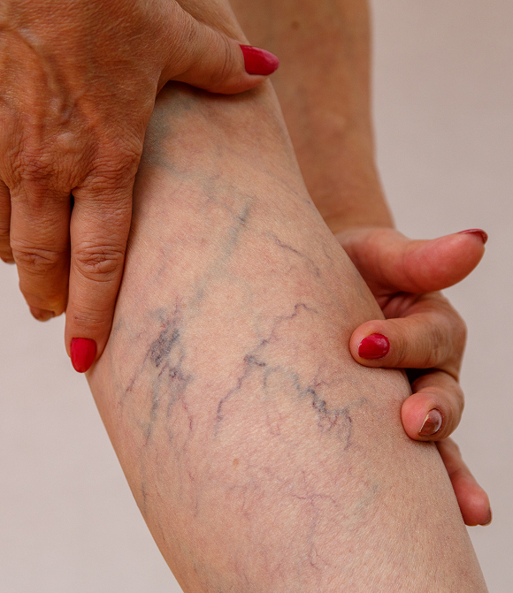 sv2 Best vein doctor near me