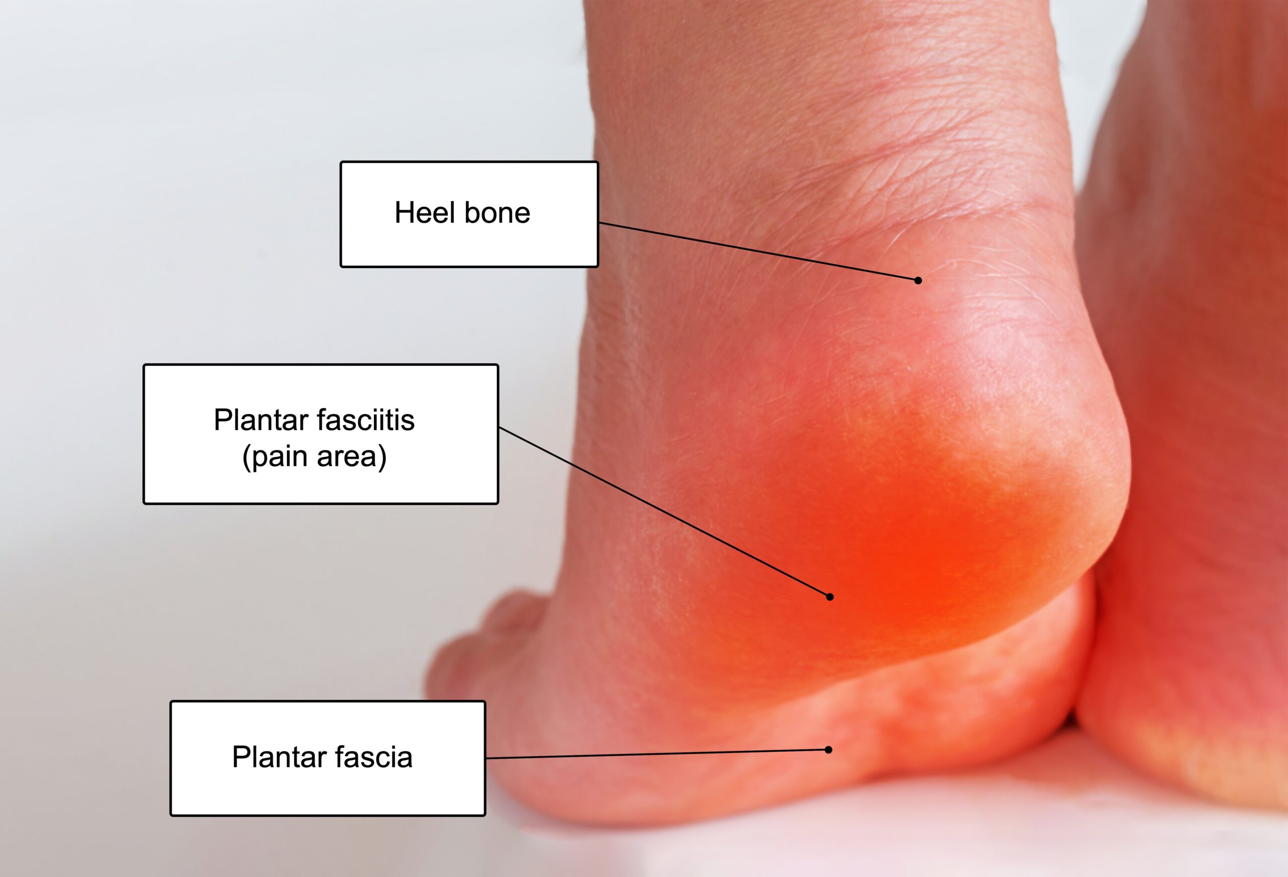 Walking After Plantar Fasciitis Embolization: When and How to Resume Activity