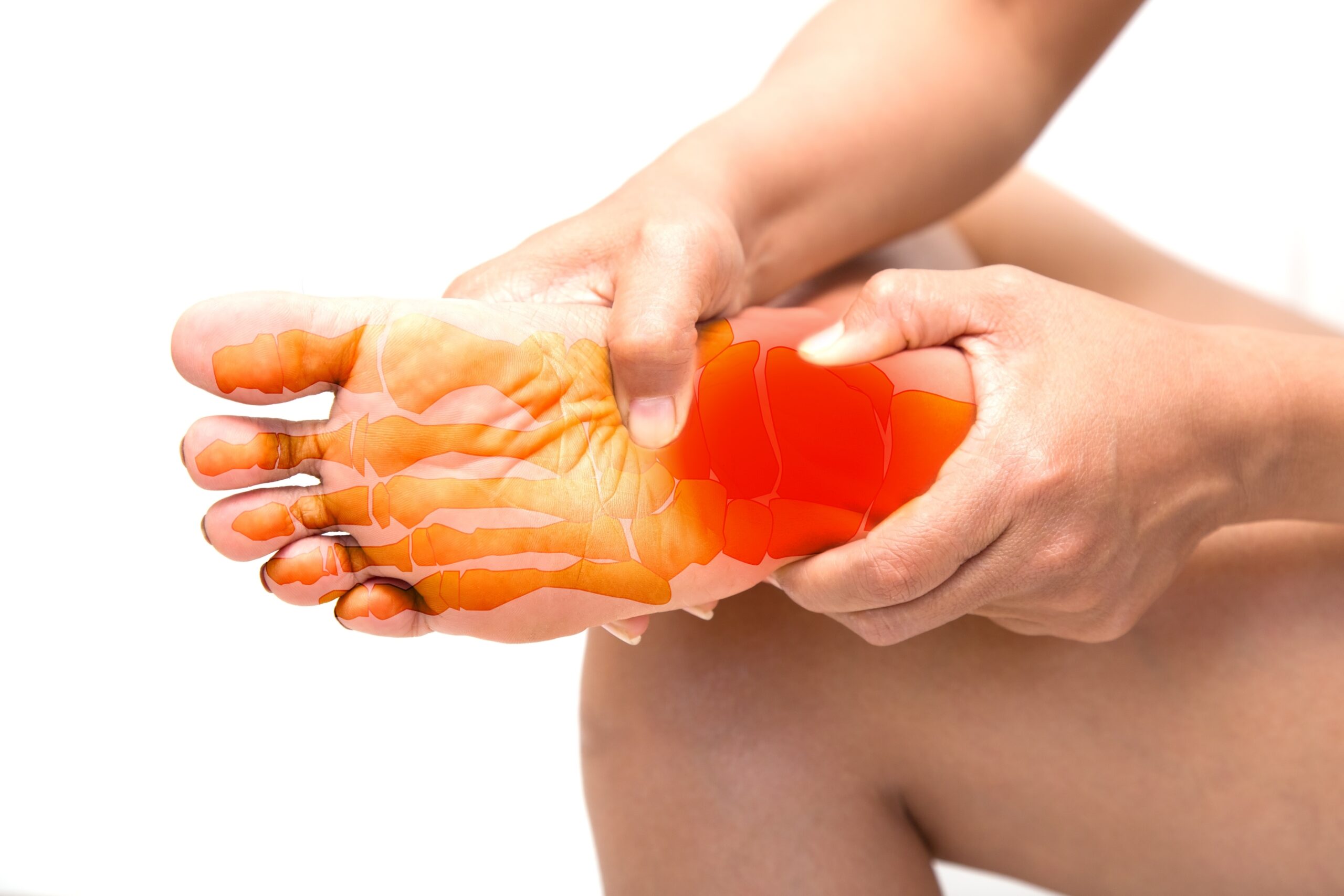 Recovery Timeline After Plantar Fasciitis Embolization (PFE)