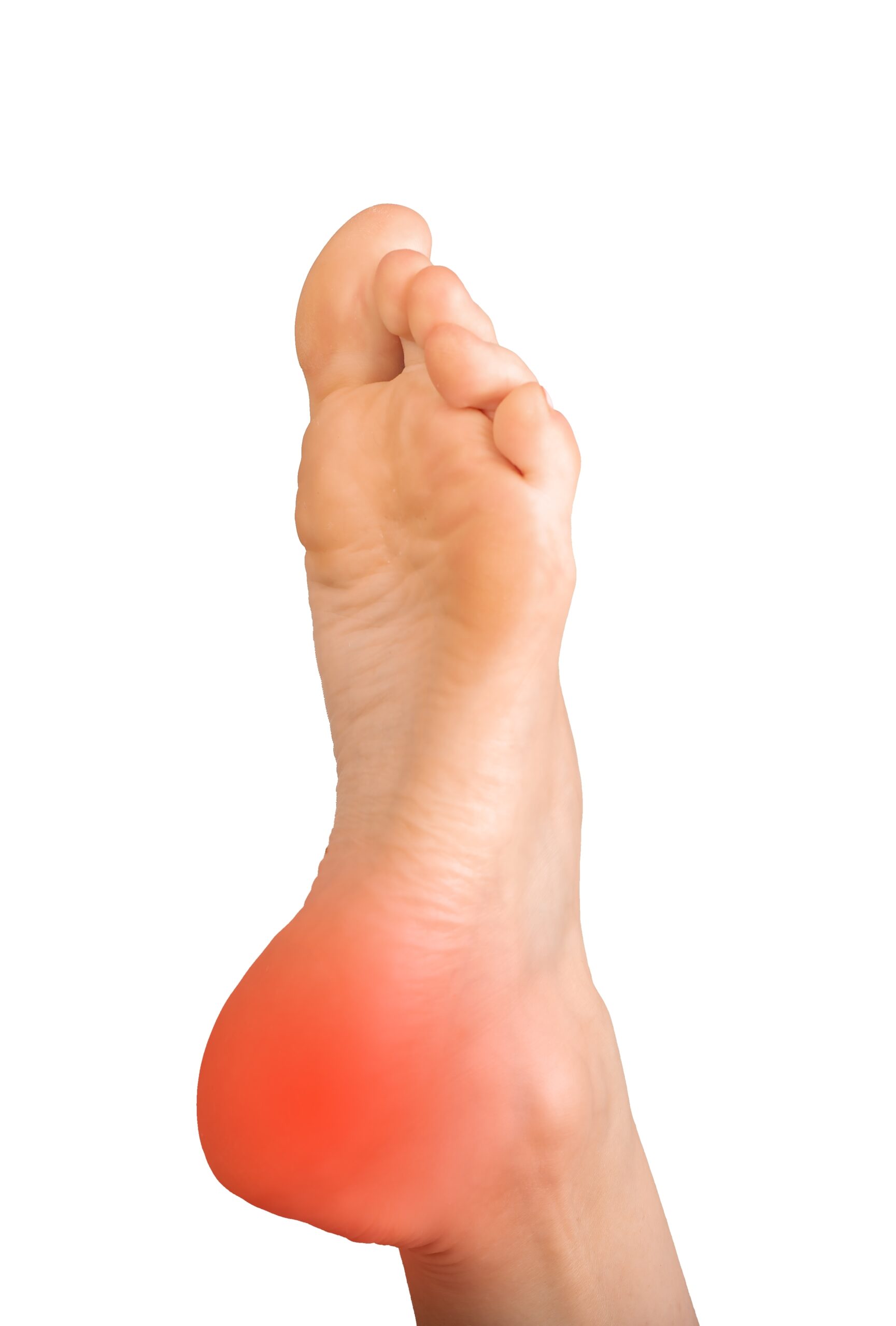 Am I a Candidate for Plantar Fasciitis Embolization (PFE)
