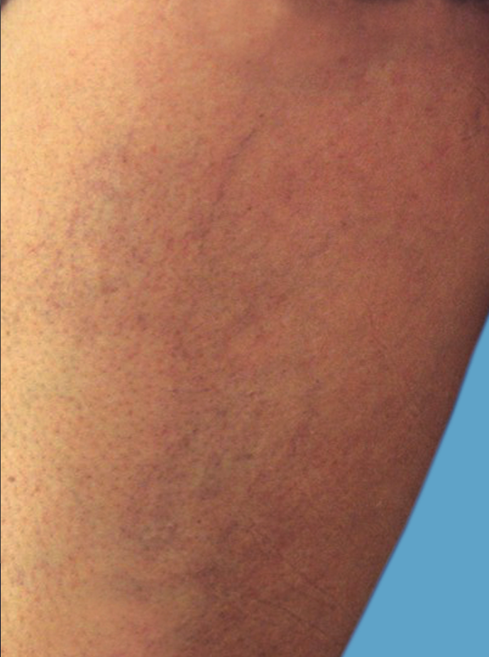 before and after varicose vein
